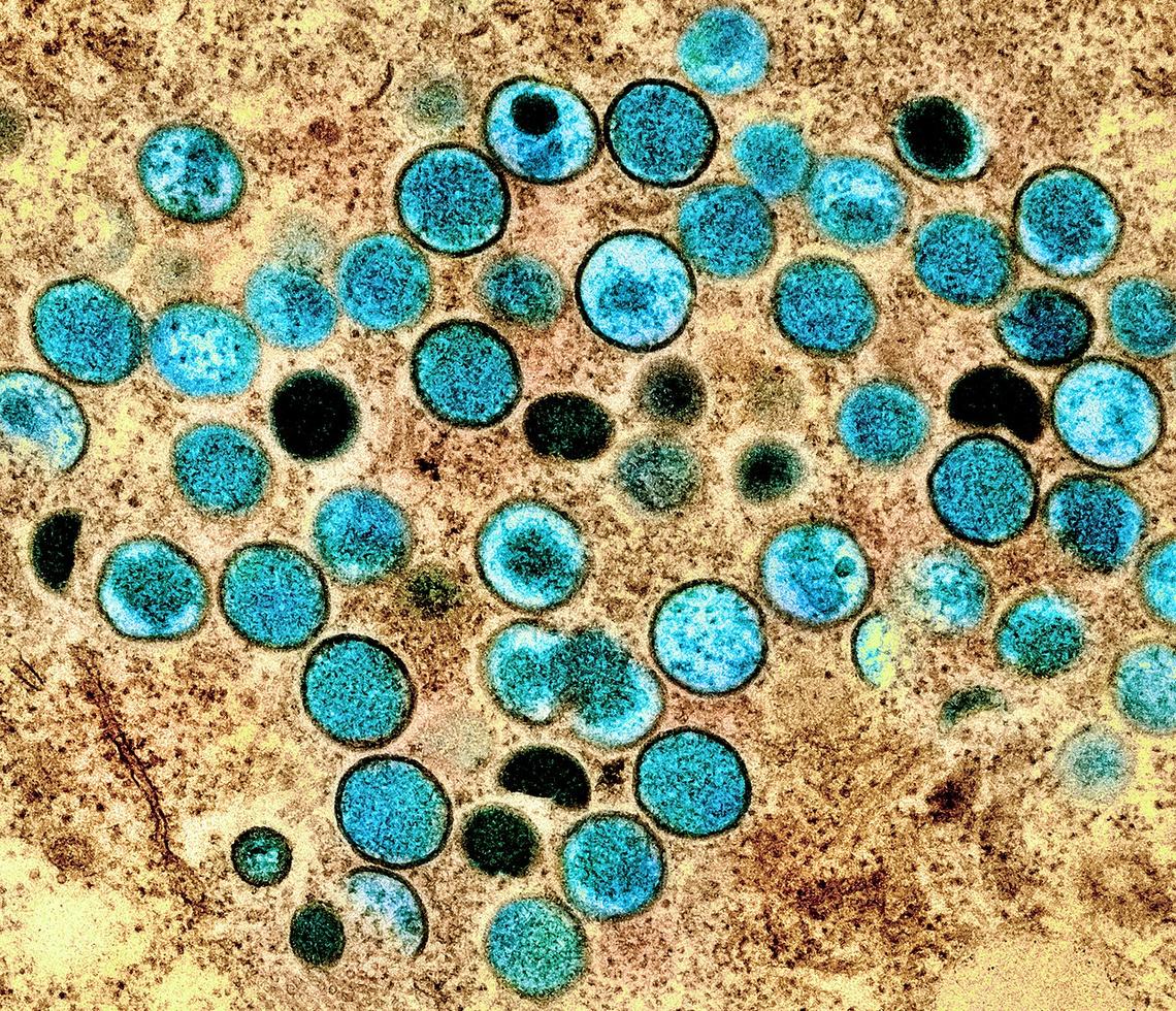 Colorized transmission electron micrograph of monkeypox particles (teal) found within an infected cell (brown), cultured in the laboratory. Image captured and color-enhanced at the NIAID Integrated Research Facility (IRF) in Fort Detrick, Maryland.